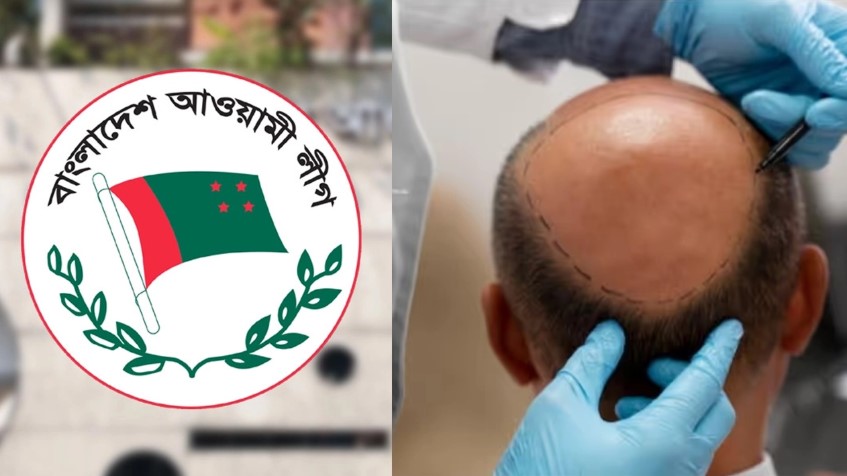 বেকার হয়ে ভারতে পলাতক সাবেক এমপি: হেয়ার ট্রান্সপ্ল্যান্ট করে নতুন জীবন শুরু