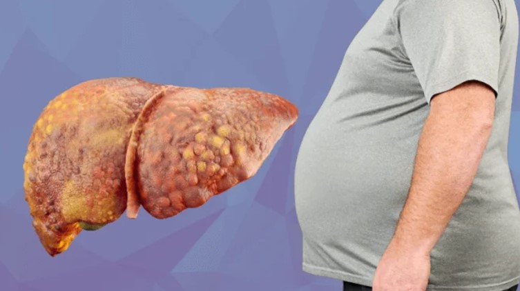 ৬০ দিনে ফ্যাটি লিভার থেকে মুক্তি: জীবনযাত্রার চাপ কমাতে ৫টি বিশেষ খাবার