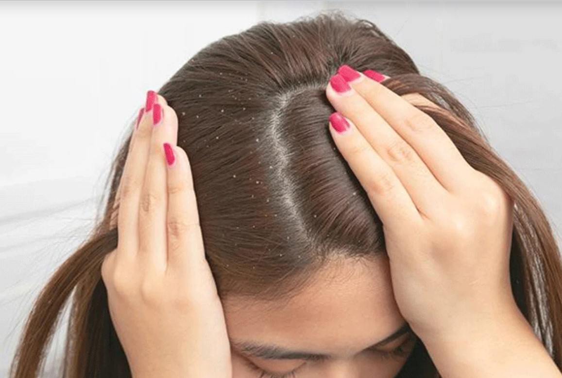 শ্যাম্পু ছাড়াও প্রাকৃতিকভাবে খুশকি কমানোর সহজ ও ঘরোয়া উপায়