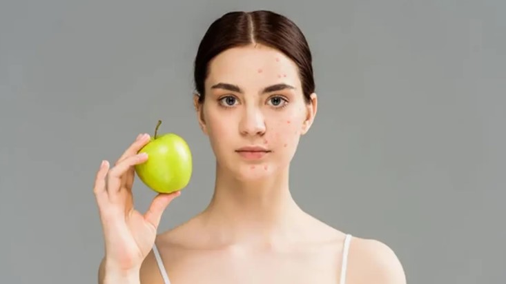 ব্রণ কমাতে আপেল কি আসলেই কাজ করে, জানুন চিকিৎসকের মত