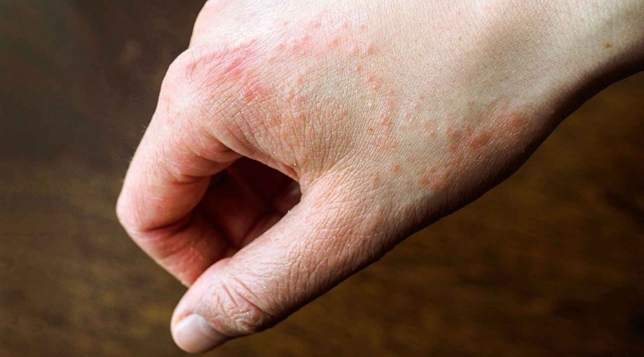 শীতে ত্বক শুষ্ক ও র্যাশ কেন হয়, জানুন সমাধান