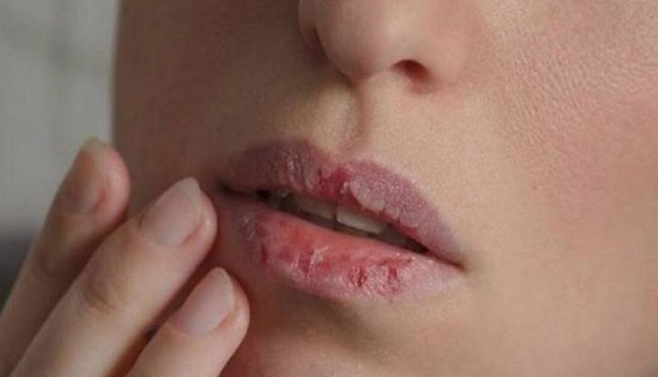 শীতে ঠোঁট ফাটা রোধে জাদুকরী ৫টি টিপস