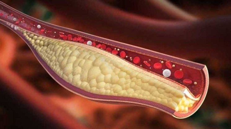 মাত্র ৩০ দিনে কোলেস্টেরল কমানোর জাদুকরী উপায়