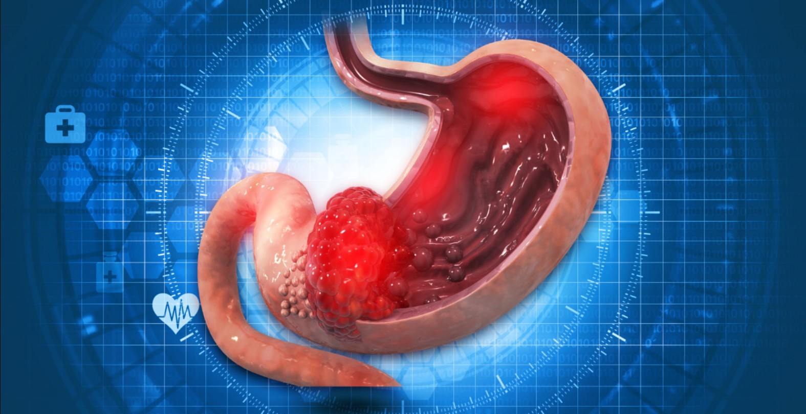 পেটের আলসার: কারণ, চিকিৎসা ও প্রতিরোধ