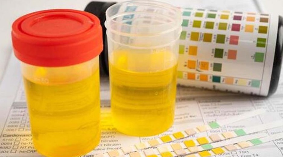 প্রস্রাবের রং কি বদলে যাচ্ছে? কিডনি বিকল হওয়ার আগাম লক্ষণ জানুন