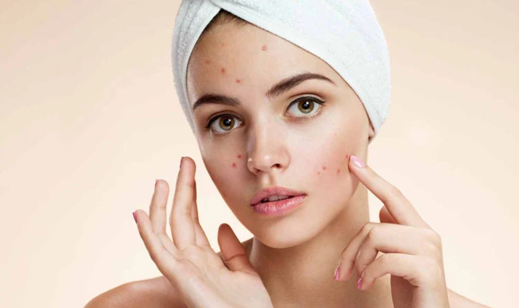 ব্রণের দাগ দূর করতে ঘরোয়া ফেসপ্যাকের কার্যকারিতা জানুন