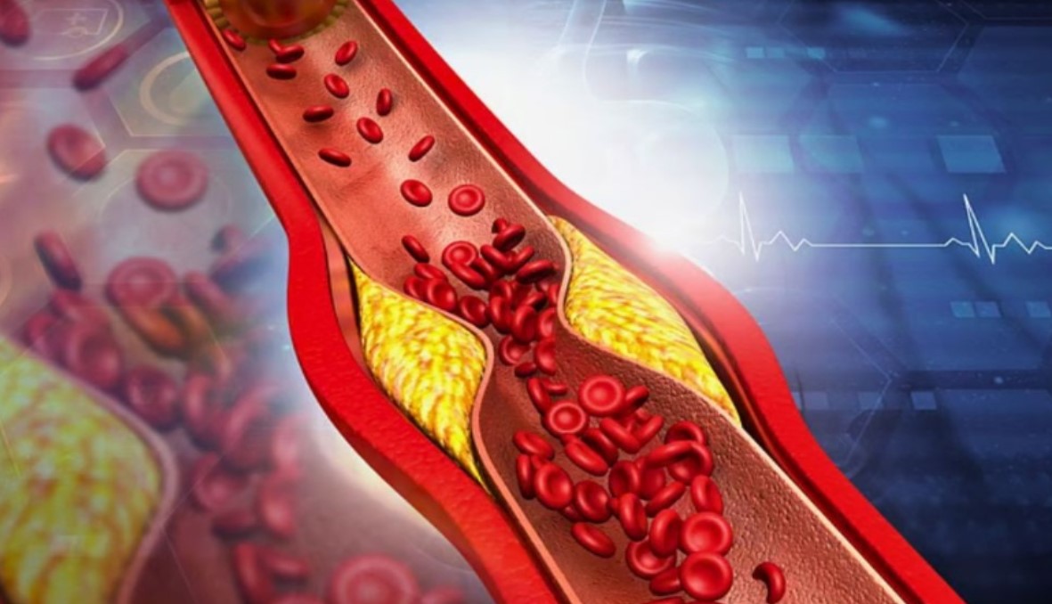 নীরব ঘাতক কোলেস্টেরল; শরীরে যে ৫টি সংকেত দেখলে দ্রুত সতর্ক হবেন