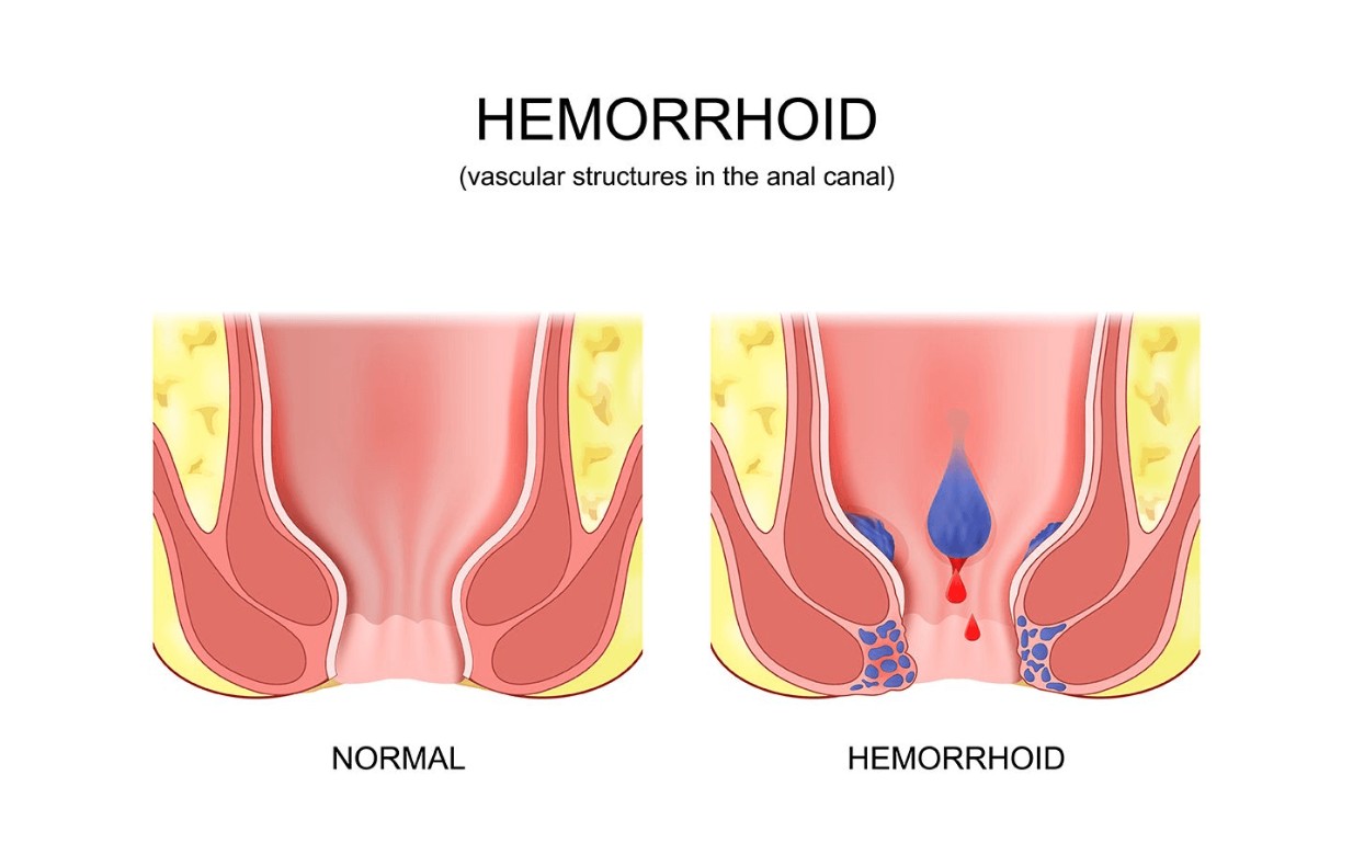 নীরবে রক্তপাত? পাইলসের  লক্ষণ, চিকিৎসা ও প্রতিরোধ জানুন