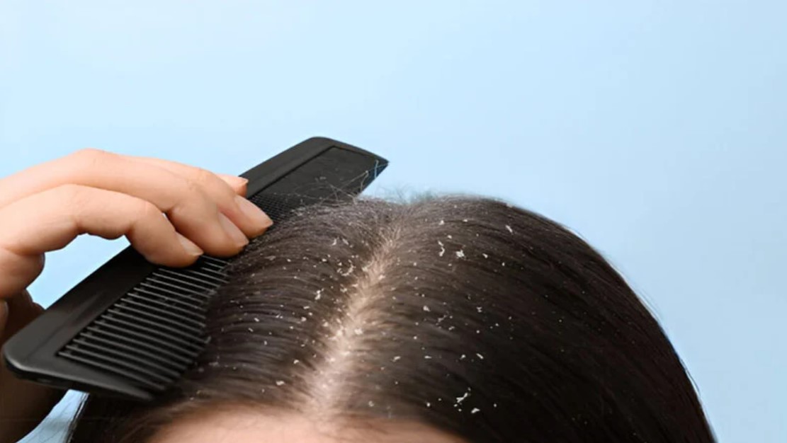 শীত শেষ হলেও খুশকির যন্ত্রণায় নাজেহাল? ঘরোয়া এই ৫টি উপায়েই মিলবে মুক্তি