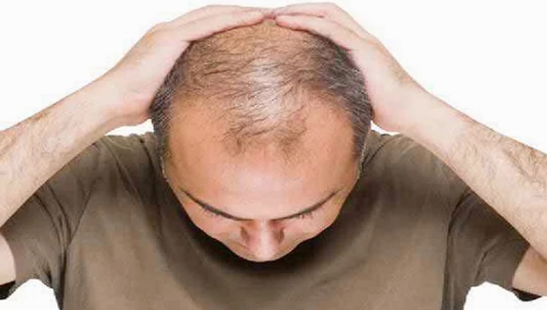 পুরুষের টাক পড়া রুখবে এসেনশিয়াল অয়েল; জেনে নিন ব্যবহারের জাদুকরী কৌশল