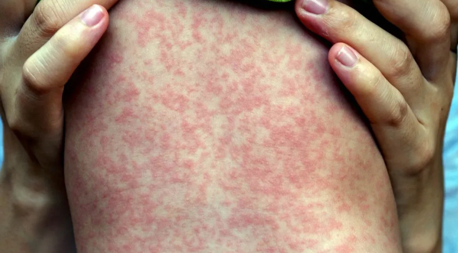 হামের লক্ষণ কীভাবে বুঝবেন, বাঁচতে কী করবেন 