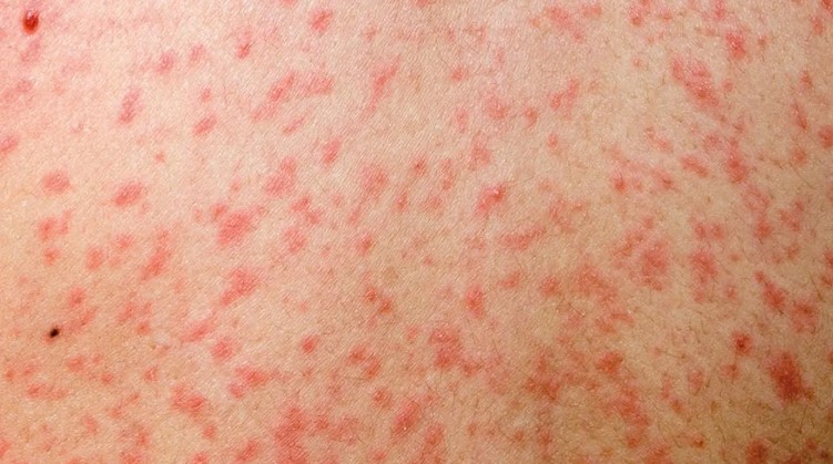 স্বাস্থ্য অধিদপ্তরের রেড অ্যালার্ট! দেশে বাড়ছে হামের প্রকোপ