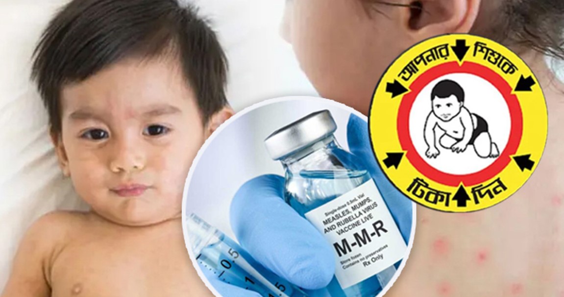 যেসব শিশুকে দেওয়া যাবে না হামের টিকা! স্বাস্থ্য মন্ত্রণালয়ের বিশেষ সতর্কতা