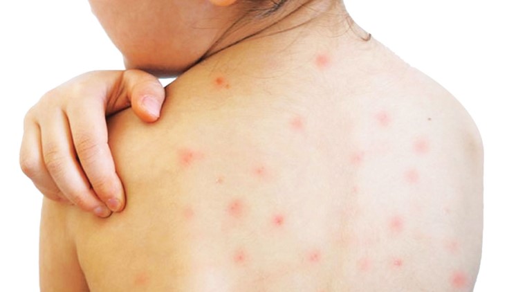 দেশে হামের মহামারি আতঙ্ক: আক্রান্ত ১১ হাজার ছাড়াল, বাড়ছে লাশের মিছিল