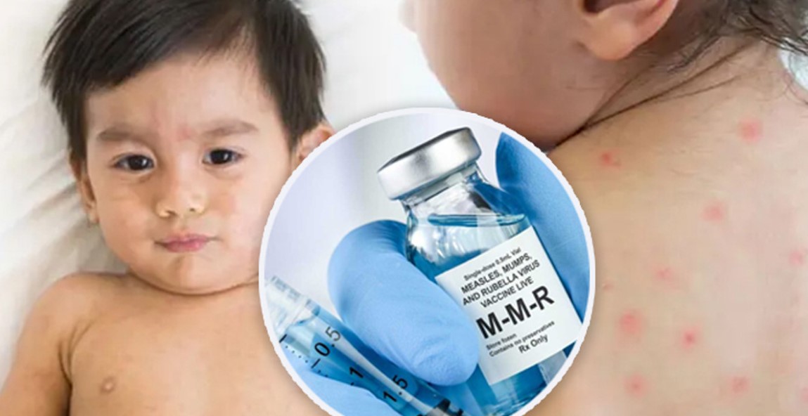 হাম রুখতে দেশজুড়ে কাল থেকে ‘মেগা’ টিকাদান কর্মসূচি