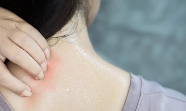 গরমে ঘামাচির যন্ত্রণায় অতিষ্ঠ? জেনে নিন মুক্তি পাওয়ার সহজ ঘরোয়া উপায়