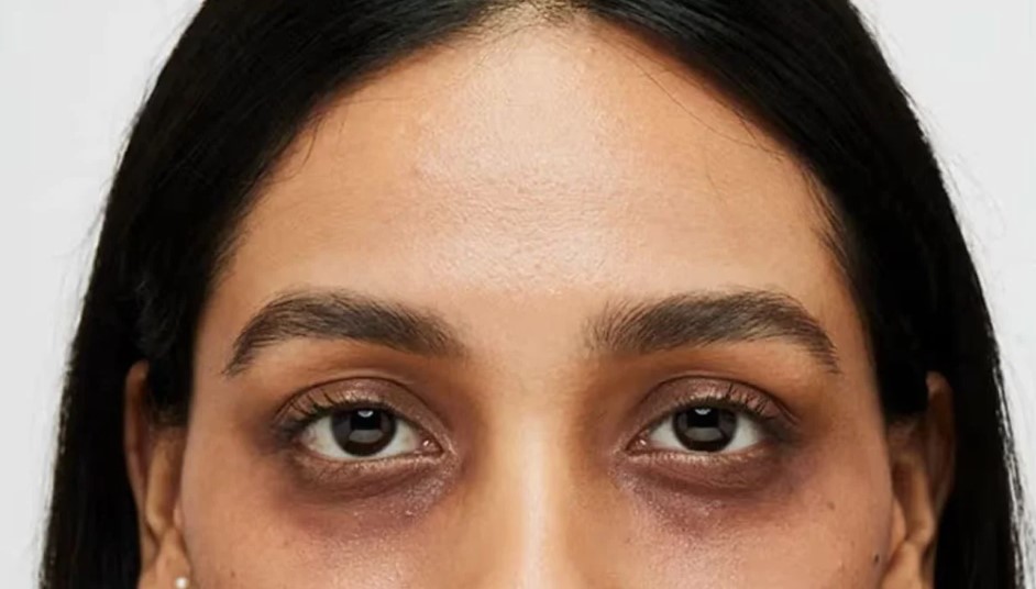 চোখের নিচে কালো দাগের পেছনে লুকিয়ে থাকা কারণ