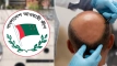 বেকার হয়ে ভারতে পলাতক সাবেক এমপি: হেয়ার ট্রান্সপ্ল্যান্ট করে নতুন জীবন শুরু