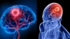 মস্তিষ্কের ক্যানসার: যে ৫টি প্রাথমিক উপসর্গ অবহেলা করা উচিত নয়