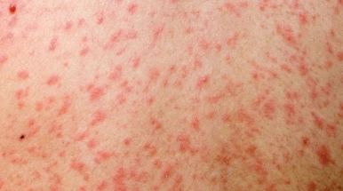 স্বাস্থ্য অধিদপ্তরের রেড অ্যালার্ট! দেশে বাড়ছে হামের প্রকোপ