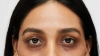 চোখের নিচে কালো দাগের পেছনে লুকিয়ে থাকা কারণ